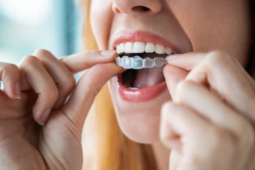 Como limpiar ferula dental