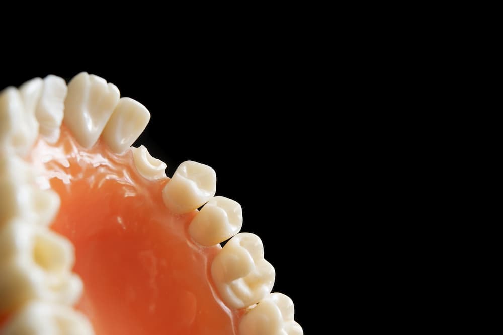 Como saber si tengo caries