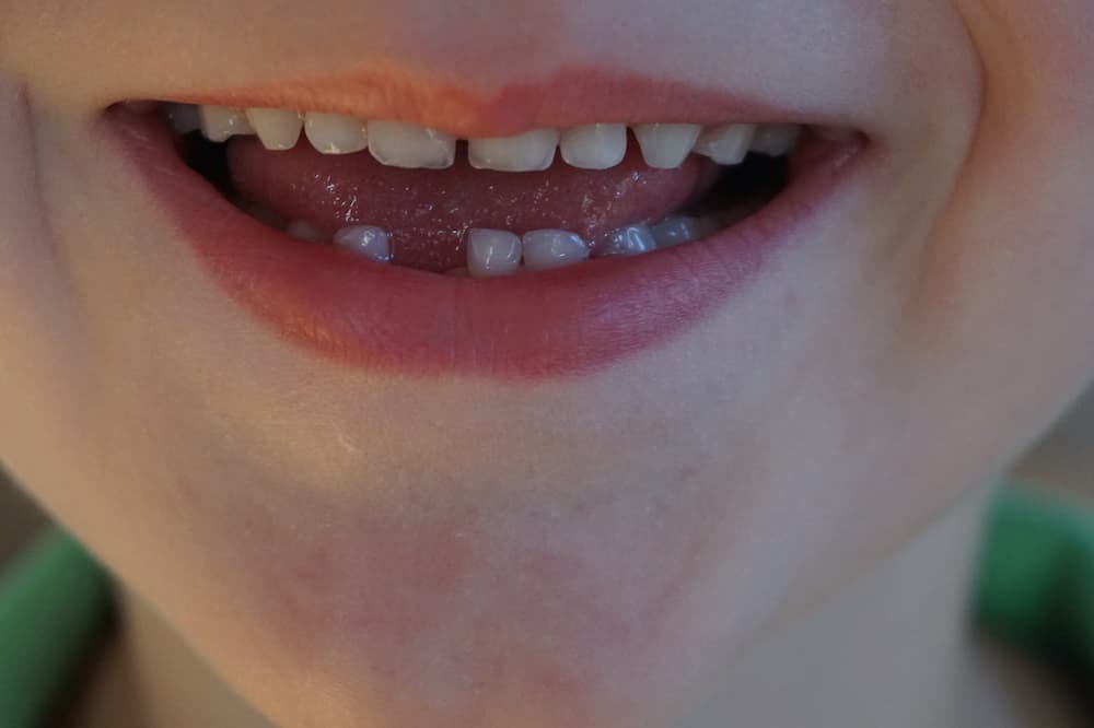 Cuando se caen los dientes de leche