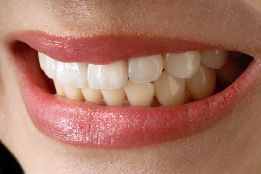 Cuanto cuestan las carillas dentales