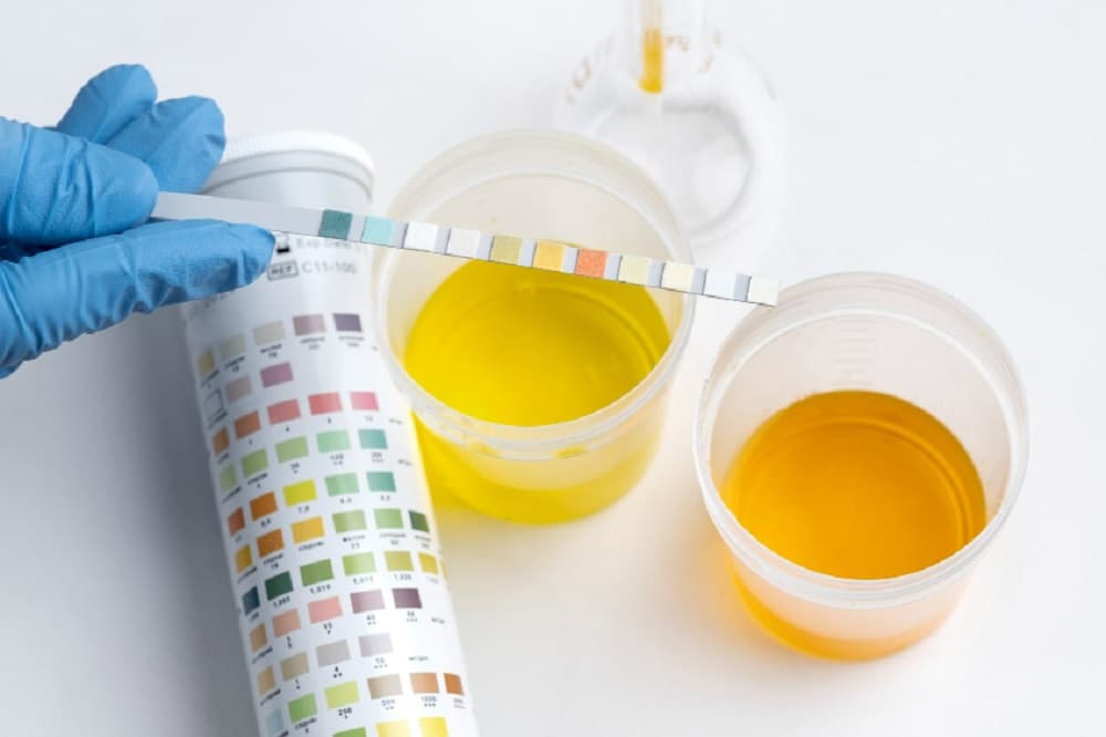 Prueba casera para saber si tienes infección de orina